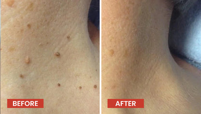 Derma Smooth Painless Skin Tag Removal Patch