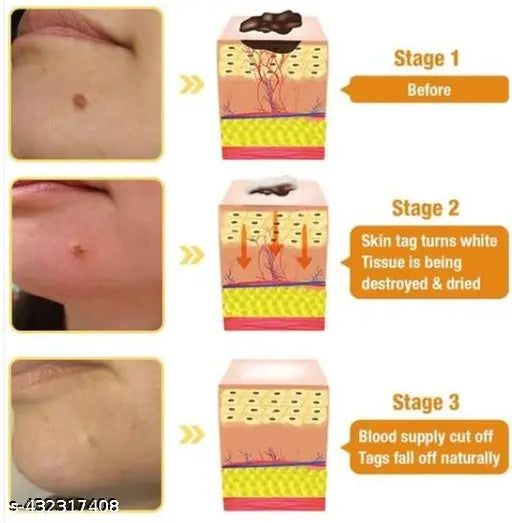 Derma Smooth Painless Skin Tag Removal Patch