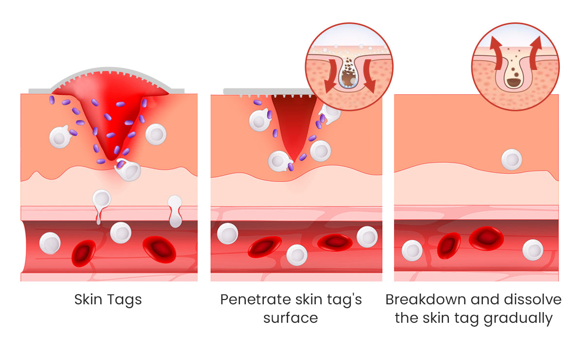 Derma Smooth Painless Skin Tag Removal Patch