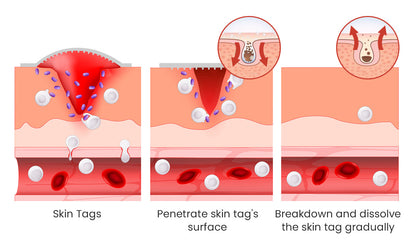 Derma Smooth Painless Skin Tag Removal Patch